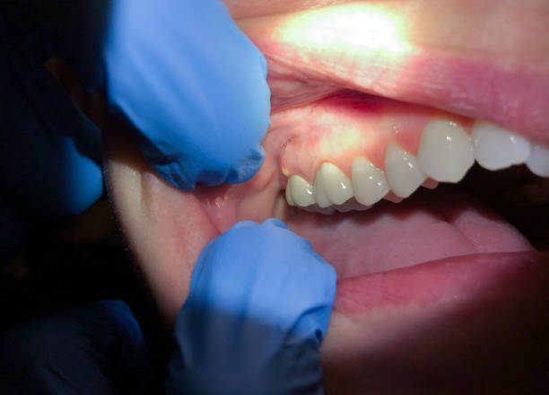 Best Emergency Tooth Extraction in Lewisburg, PA